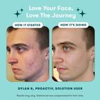 Proactiv 3 Step Acne Treatment Kit + Patches