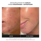 Paula's Choice 2% BHA Liquid Exfoliant