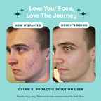 ClearSkin 3-Step Acne Care Kit: Wash, Treat, Tone - Beauty & Personal Care by Handbags Specialist Headquarter | Available at Handbags Specialist Headquarter