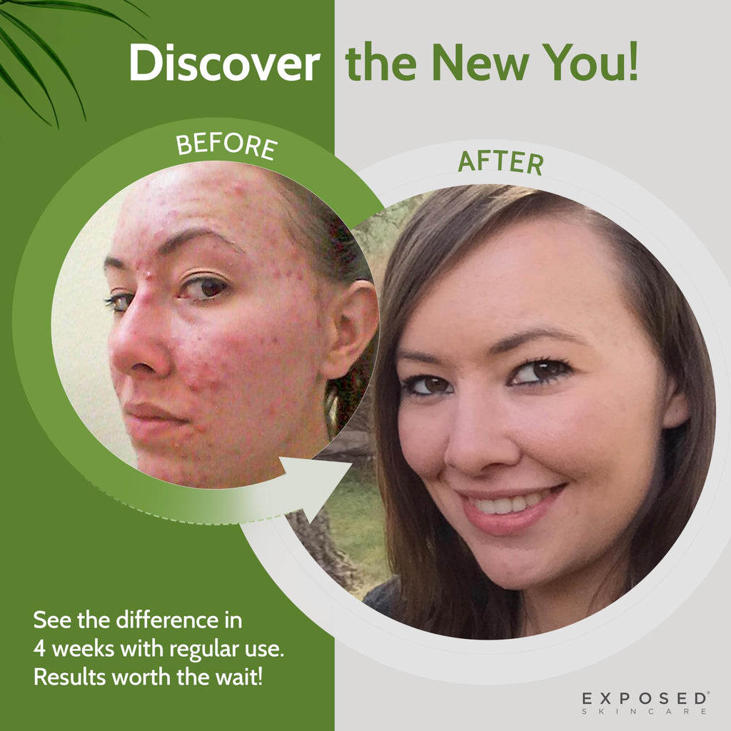 ClearSkin Duo: Natural Acne Solution Kit - Beauty & Personal Care by Handbags Specialist Headquarter | Available at Handbags Specialist Headquarter