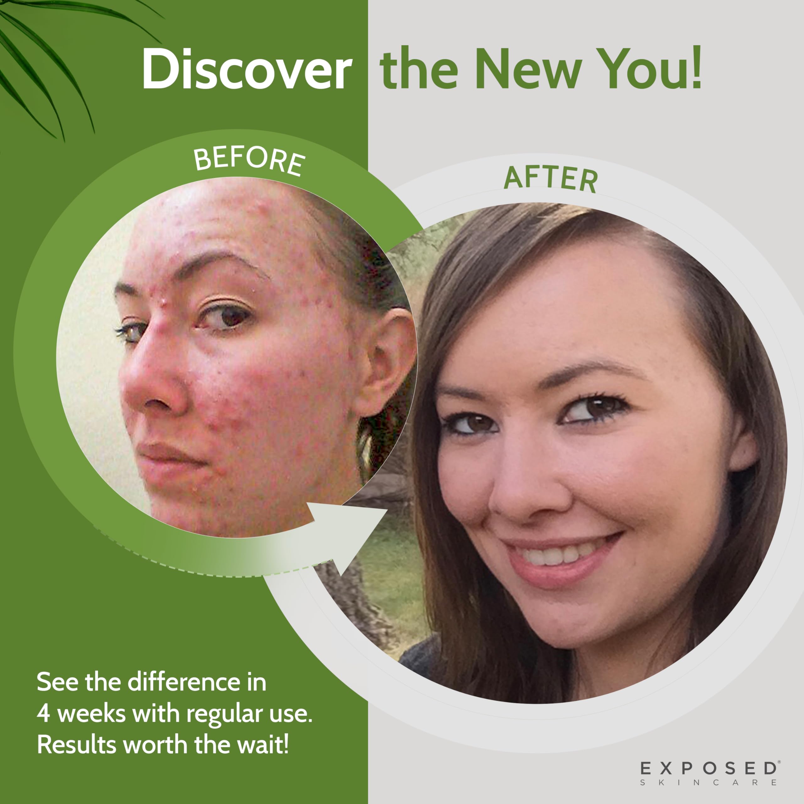 ClearSkin Duo: Natural Acne Solution Kit - Beauty & Personal Care by Handbags Specialist Headquarter | Available at Handbags Specialist Headquarter