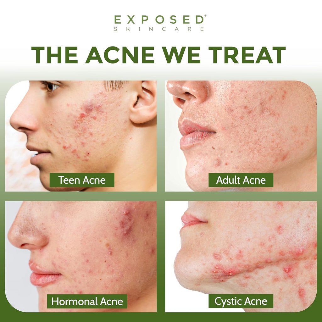 ClearSkin Duo: Natural Acne Solution Kit