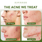 ClearSkin Duo: Natural Acne Solution Kit