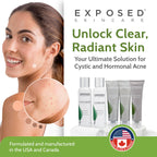 ClearSkin Duo: Natural Acne Solution Kit - Beauty & Personal Care by Handbags Specialist Headquarter | Available at Handbags Specialist Headquarter