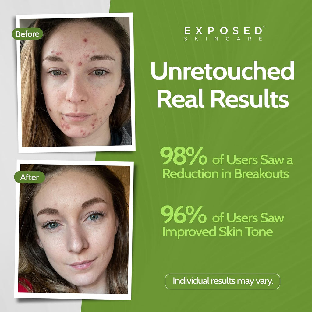 ClearSkin Duo: Natural Acne Solution Kit