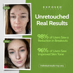 ClearSkin Duo: Natural Acne Solution Kit