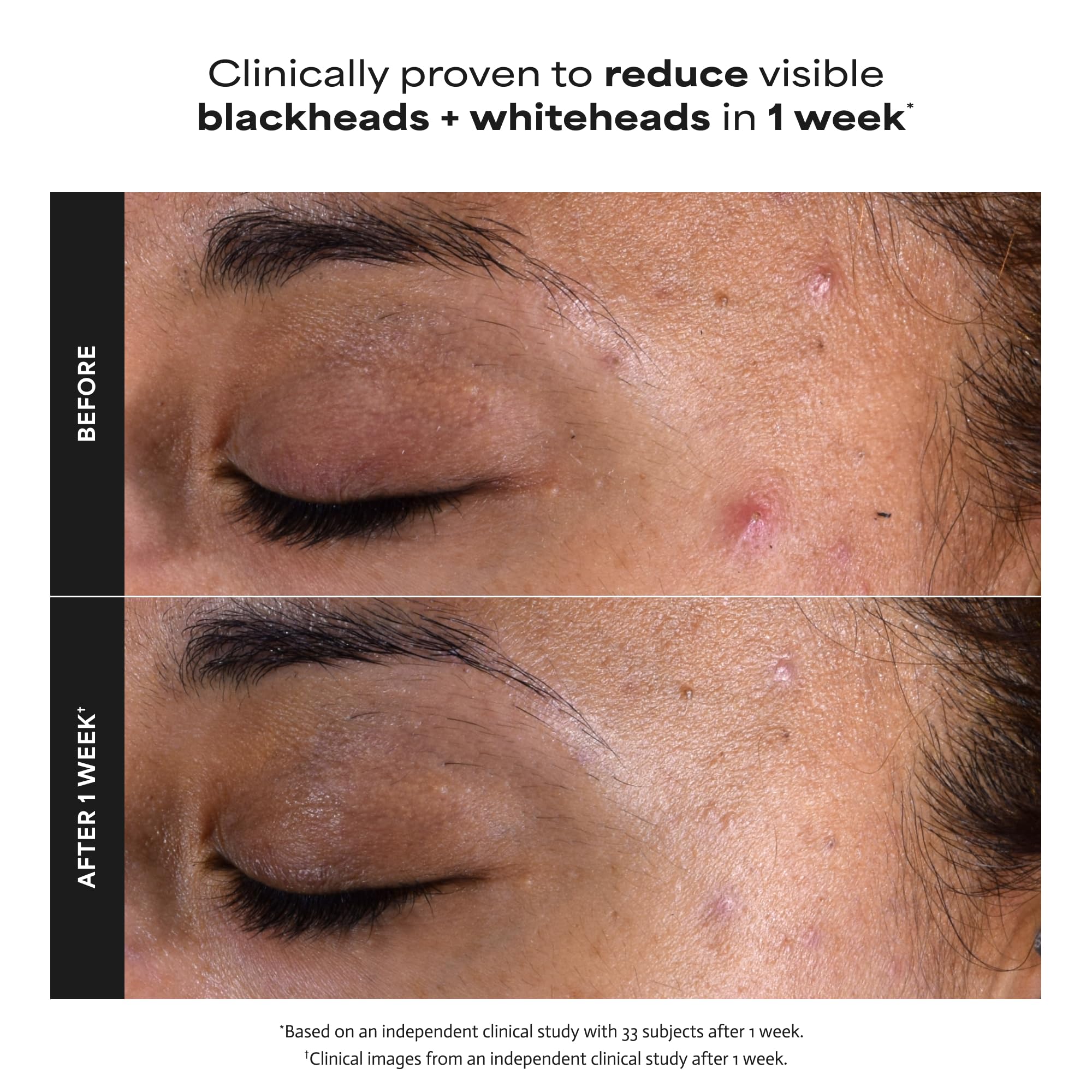 Paula's Choice 2% BHA Liquid Exfoliant