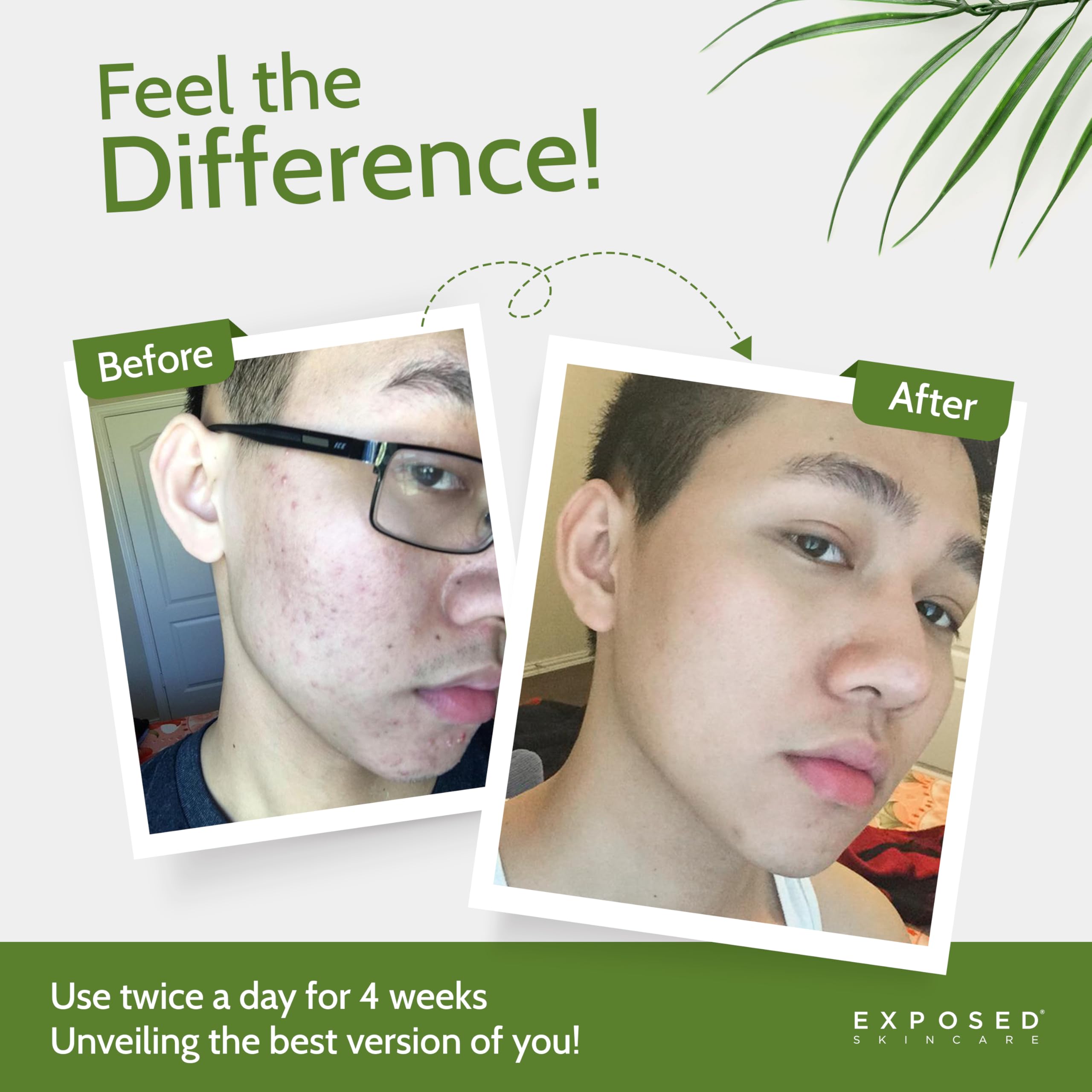 ClearSkin Duo: Natural Acne Solution Kit - Beauty & Personal Care by Handbags Specialist Headquarter | Available at Handbags Specialist Headquarter